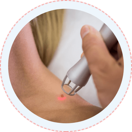 Mole Removal toronto