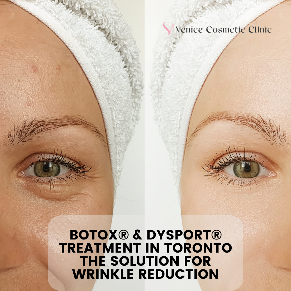 Botox® & Dysport® Treatment in Toronto The Solution for Wrinkle Reduction