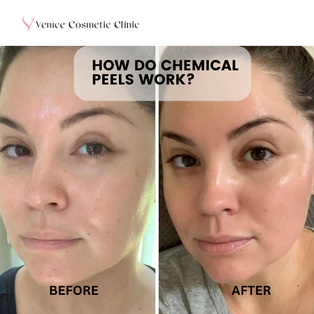 chemical peels work