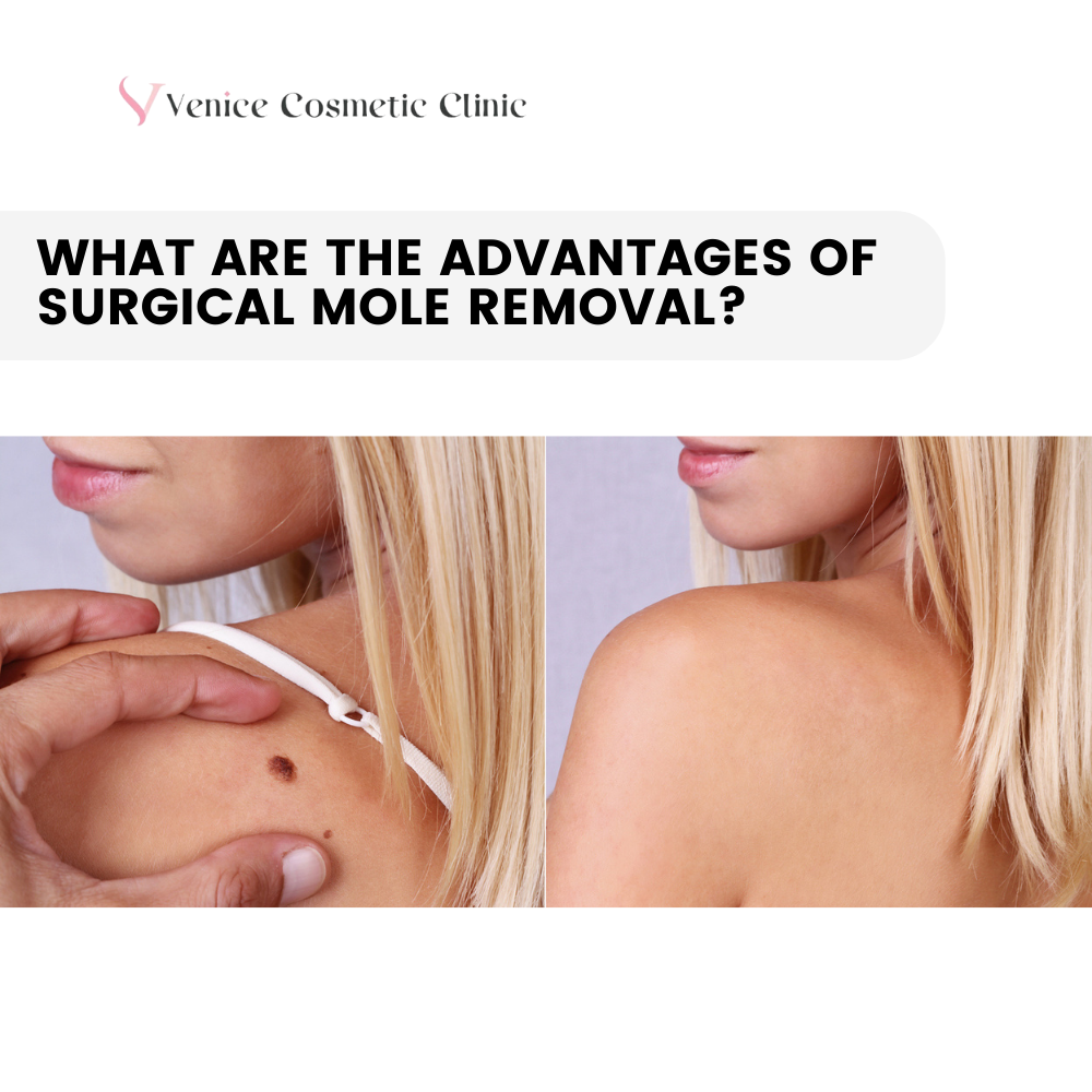 advantages of surgical mole removal