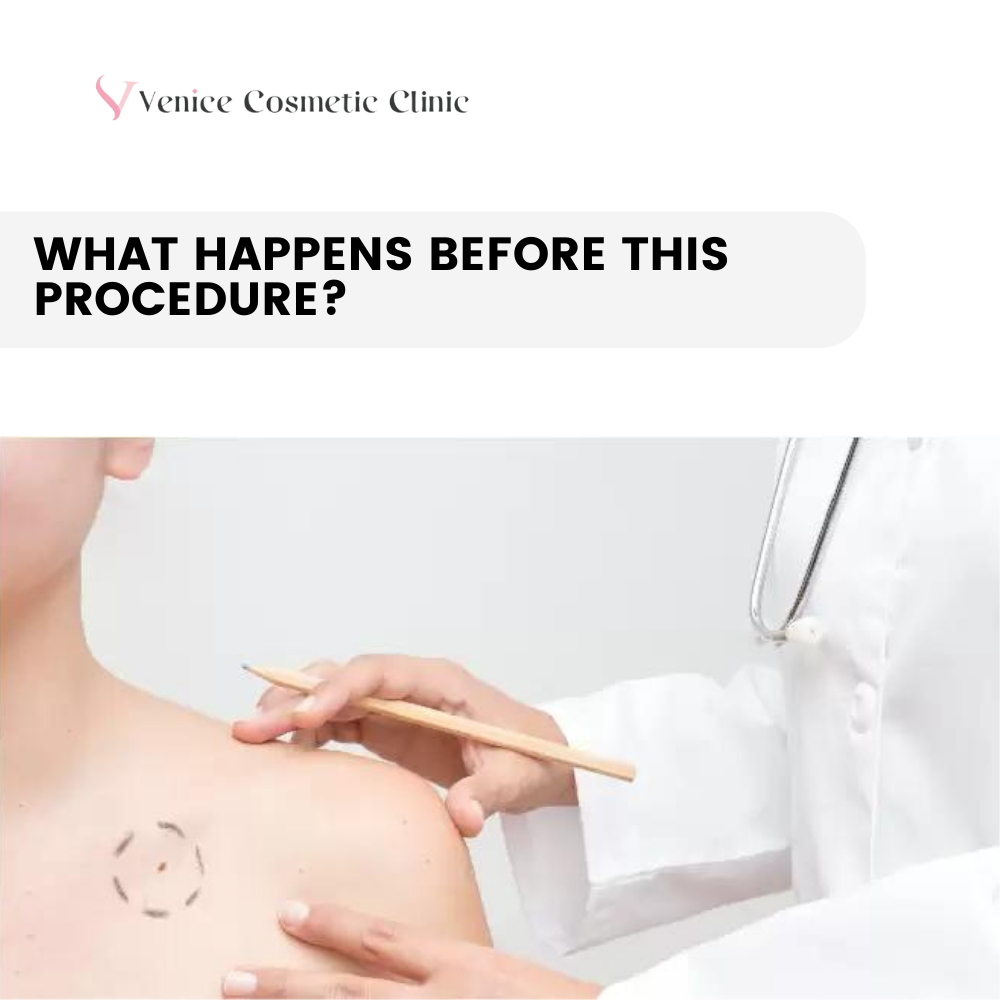 What happens before this procedure?