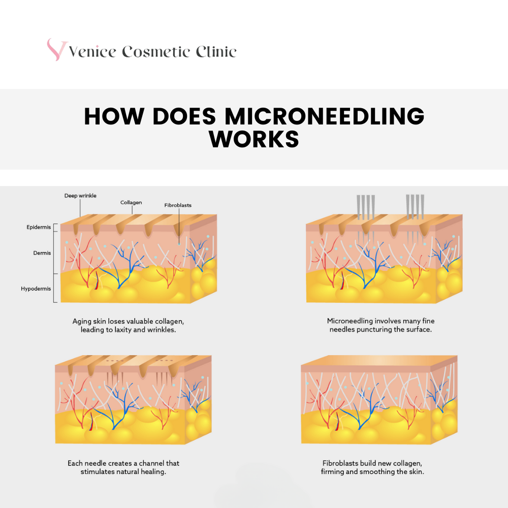 How Does Microneedling Work?