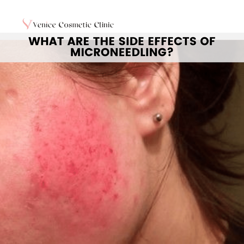  side effects of Microneedling?