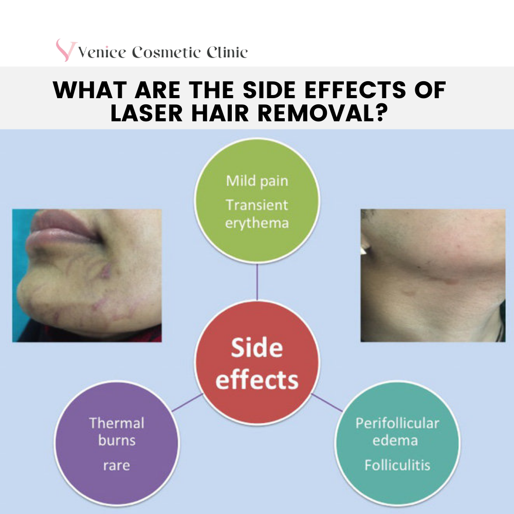 Side Effects Of Laser Hair Removal