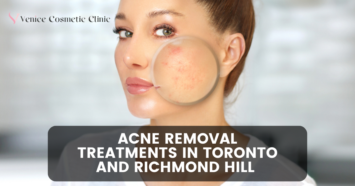Acne Removal Treatments In Toronto and Richmond Hill 1 Acne Removal Treatments In Toronto and Richmond Hill