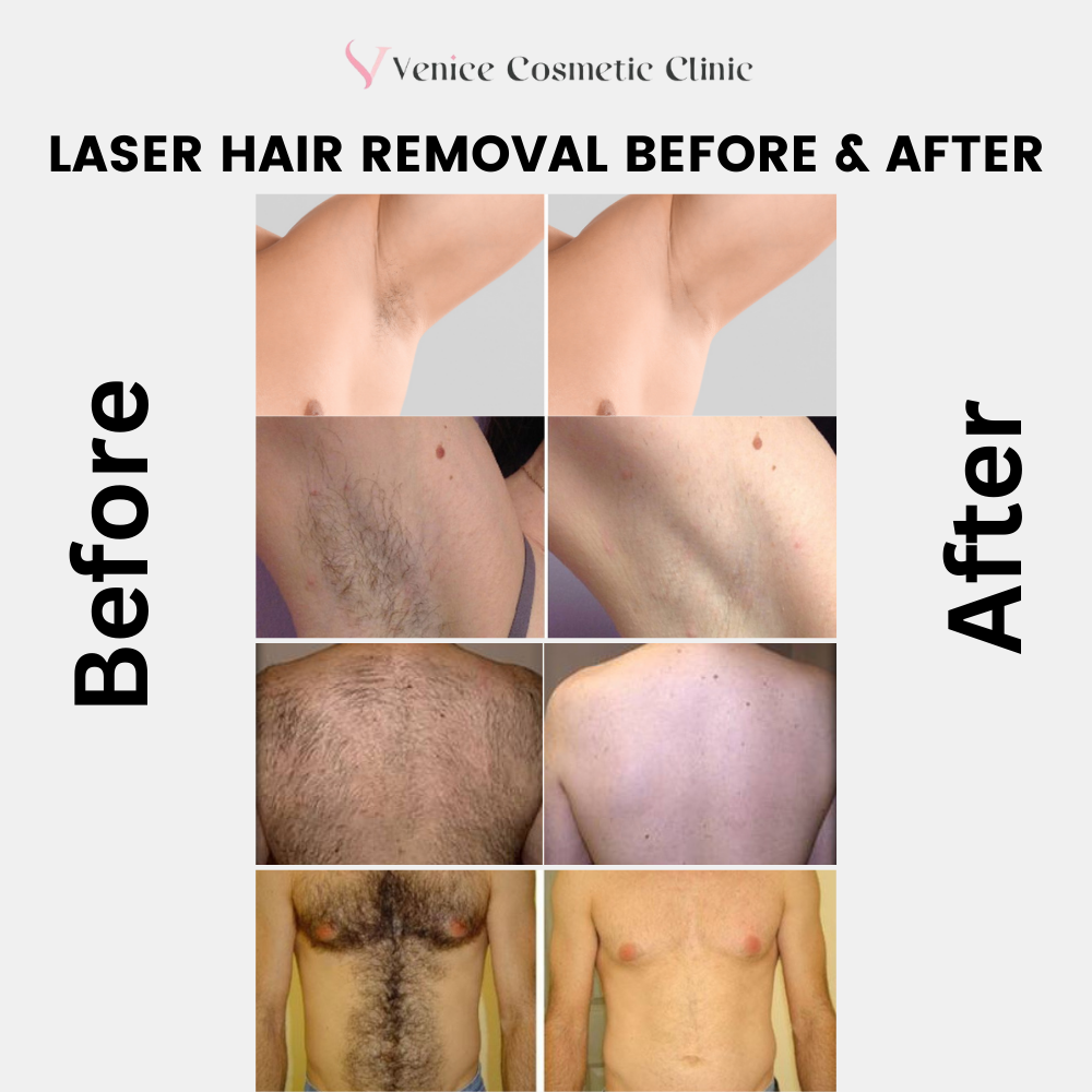 Laser hair removal clearance toronto