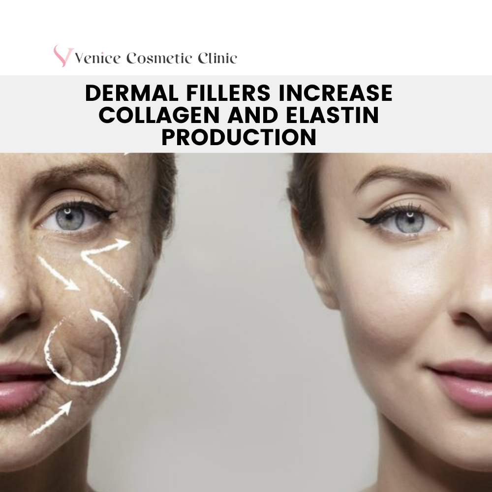 Dermal Fillers Increase Collagen and Elastin Production