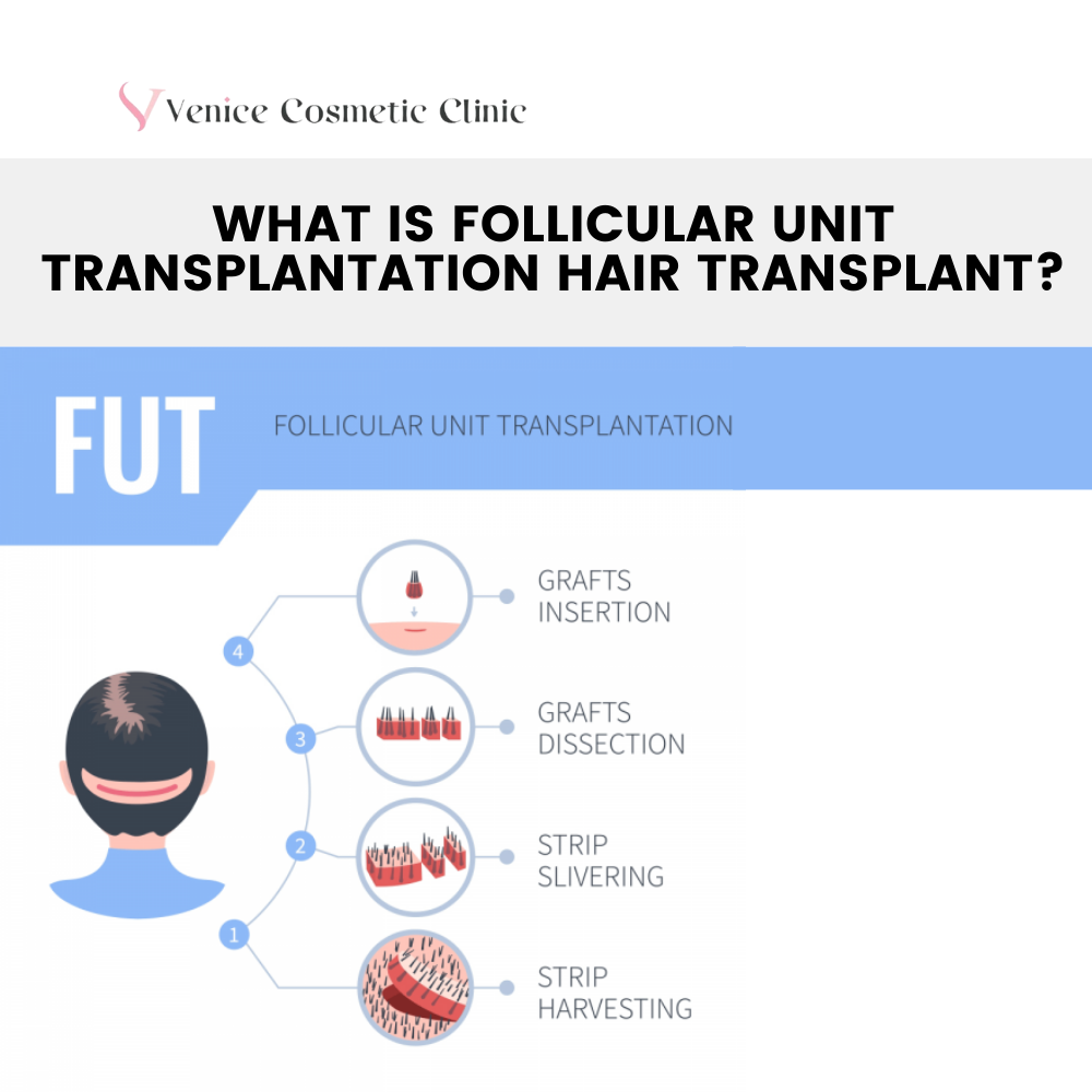 Follicular Unit Extraction (FUE)