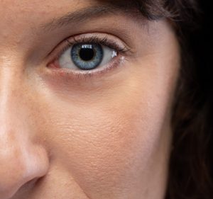 Where on the Face Can BOTOX® Be Injected? 15 After BOTOX Treatment for crow's feet