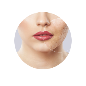 Acne Scar Removal